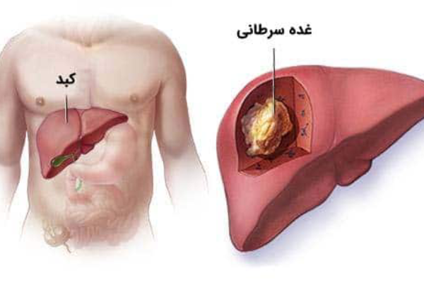روشهای تشخیص سرطان کبد