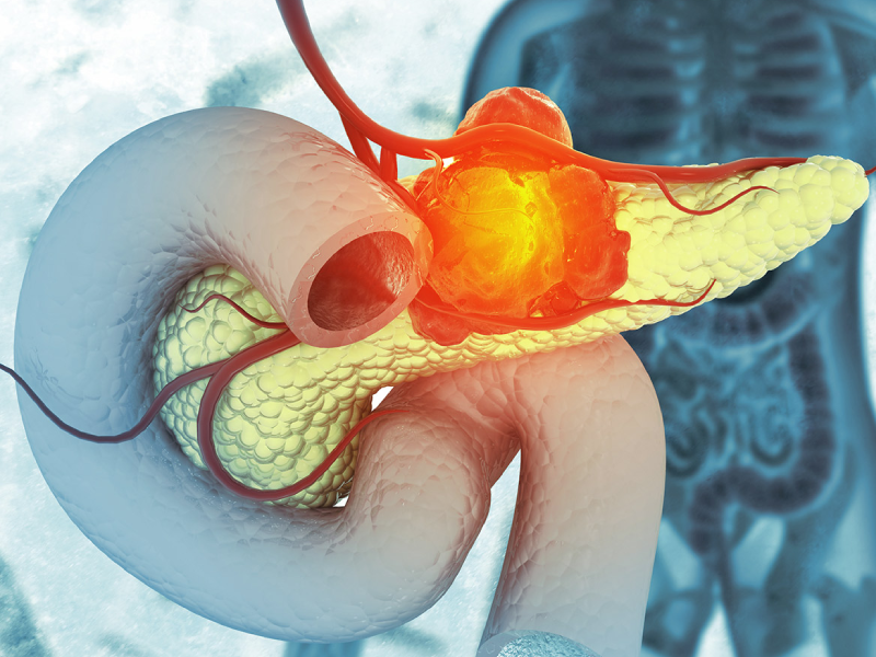 سرطان پانکراس چیست؟