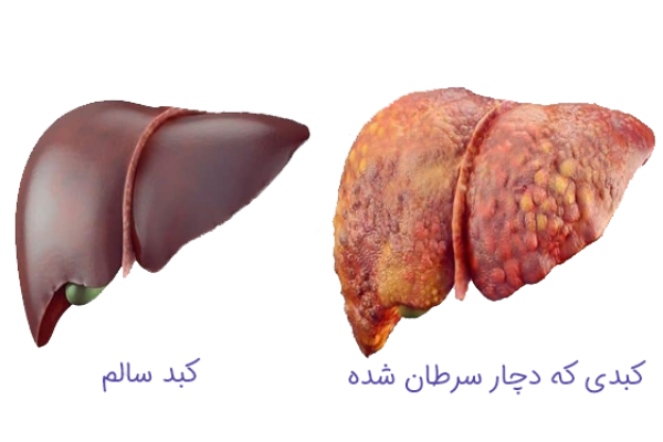سرطان کبد چیست؟