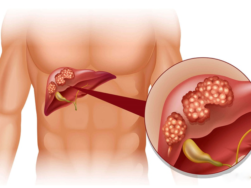 سرطان کبد: از علائم اولیه تا مراحل پیشرفته