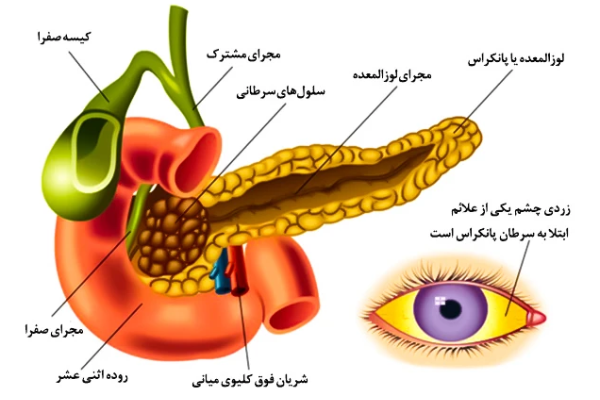 علائم پیشرفته سرطان پانکراس