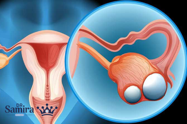 به روز ترین روشهای درمان سرطان تخمدان