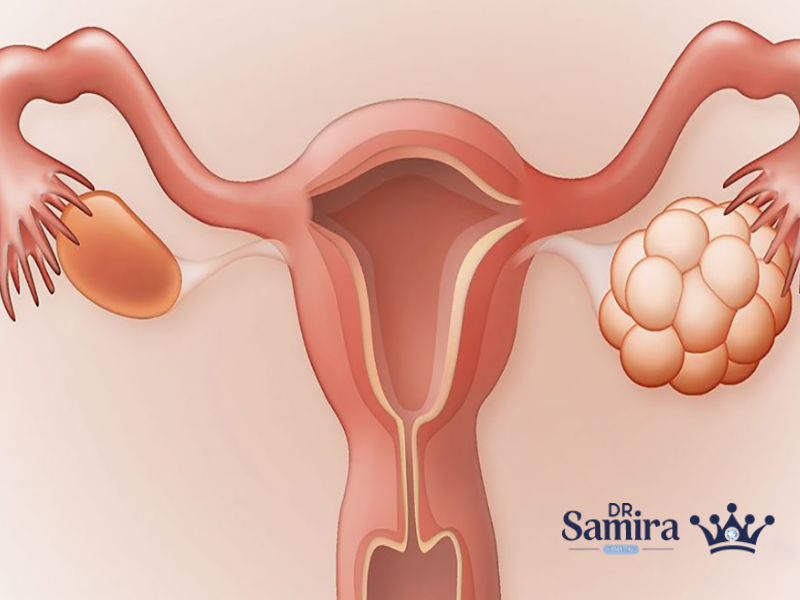 درمان سرطان تخمدان
