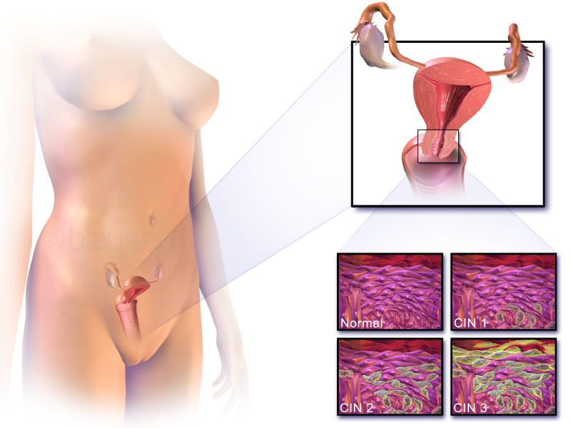سرطان رحم - شاخص