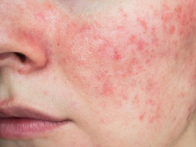 سرطان پوست چگونه به وجود می‌آید و چه کسانی در معرض آن هستند؟