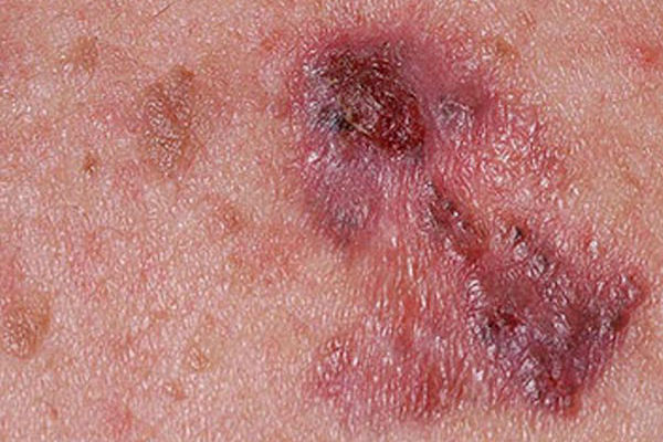 سرطان پوست چیست؟