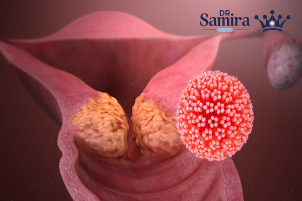 عوامل خطر سرطان رحم