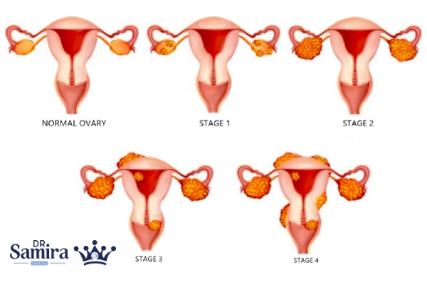 مشاوره پزشکی برای درمان سرطان تخمدان