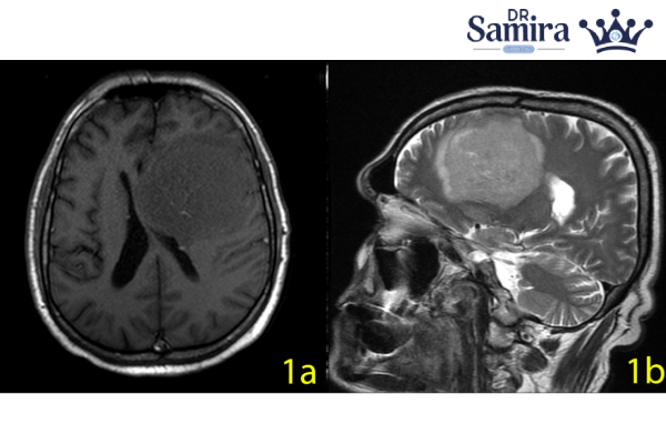 معیارهای پاتولوژیک در مننژیوم آتیپیک
