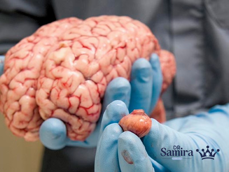 مننژیوم گرید دو یا آتیپیک چیست؟