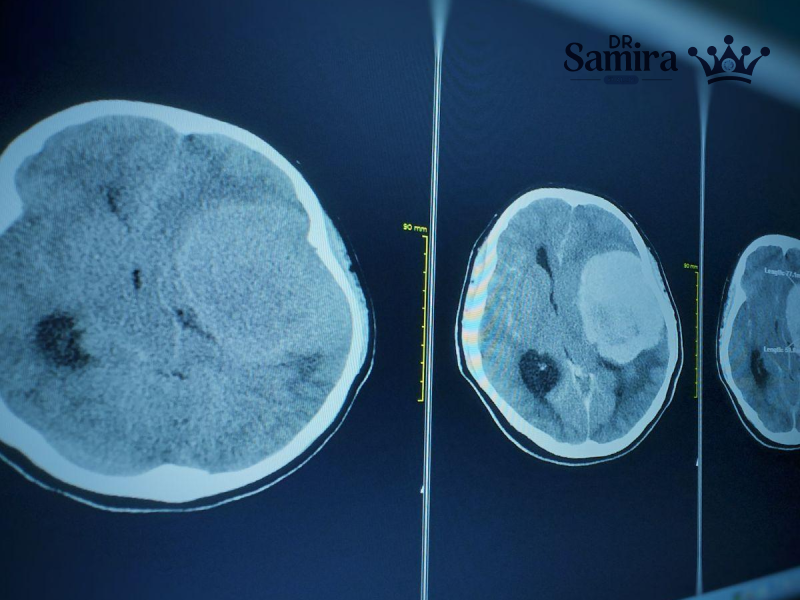 مننژیوم گرید ۳: تشخیص، ویژگی ها و روش های درمان