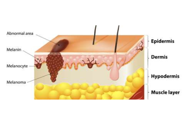 پیشرفت سرطان پوست در صورت بی توجهی