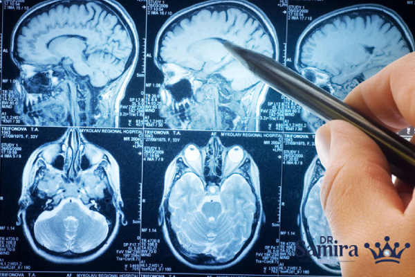 پیشگیری از مننژیوم آتیپیک