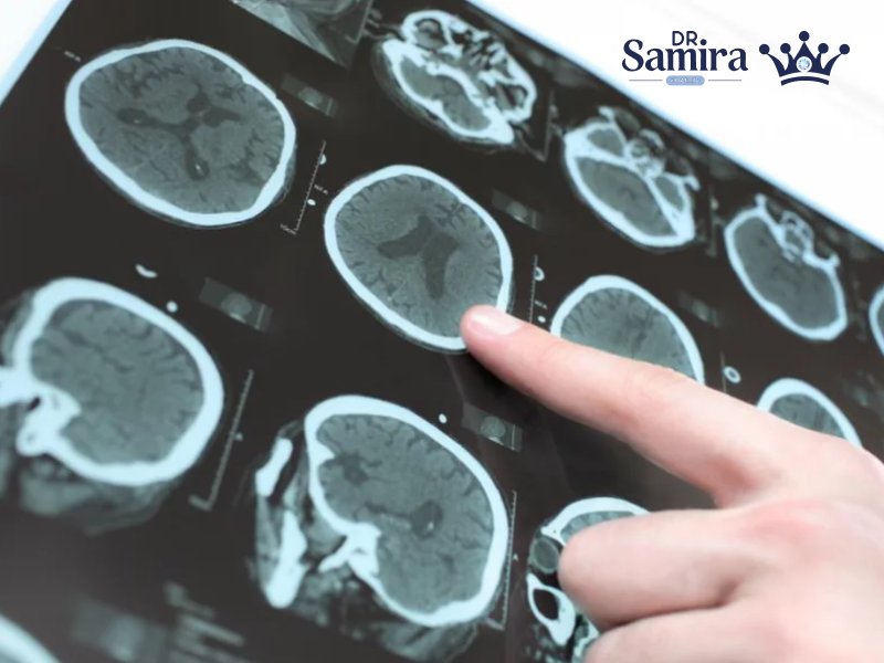 آستروسیتوم گرید دو