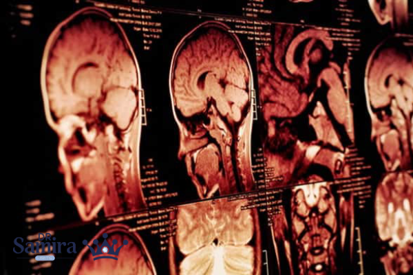 روش تشخیص مننژیوم گرید 1