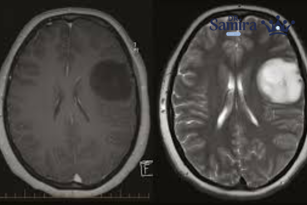 عوامل موثر در عود اپاندیموم گرید ۲ مغز