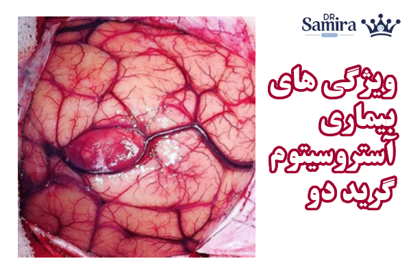ویژگی های بیماری آستروسیتوم گرید دو
