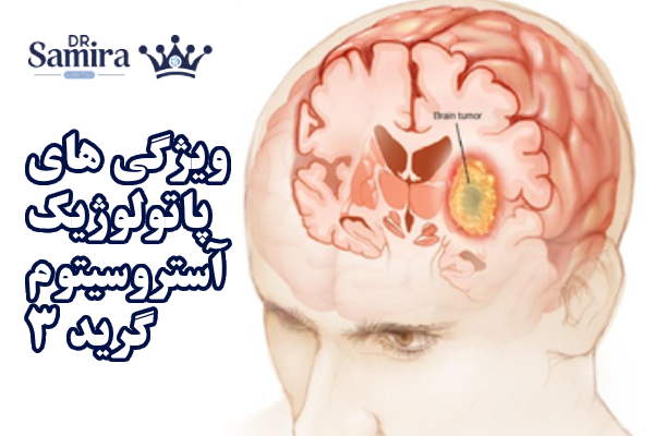 ویژگی های پاتولوژیک آستروسیتوم گرید ۳