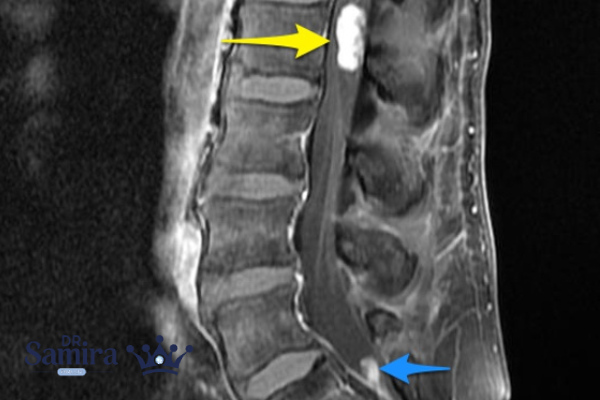 چه کسانی به میکسو پاپیلاری اپاندیمومای نخاع مبتلا میشوند؟