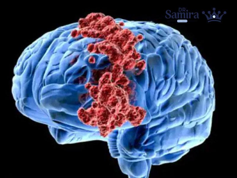 الیگودندروگلیوم گرید ۲