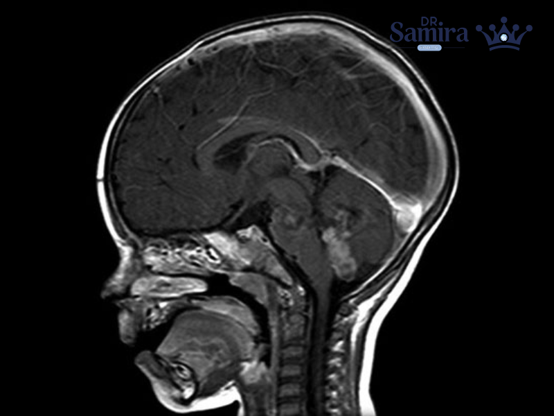 اپاندیموم گرید ۳: شناخت علائم و روش‌های درمان