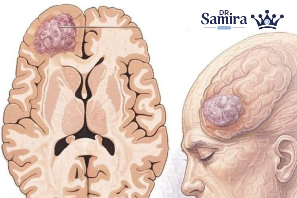 اپیدمیولوژی گلیوبلاستوم