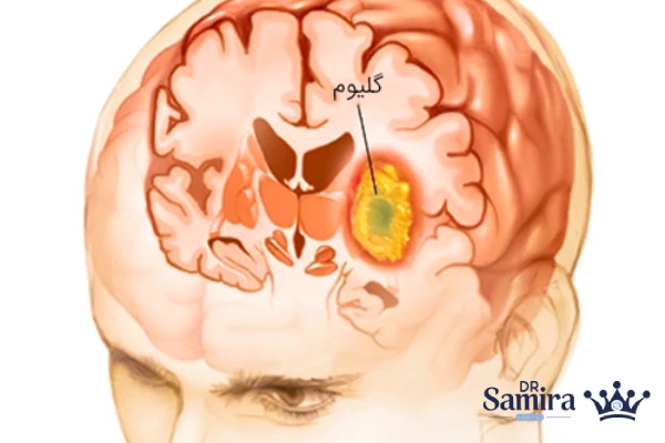 تفاوت گلیوم ساقه مغز در کودکان و بزرگسالان