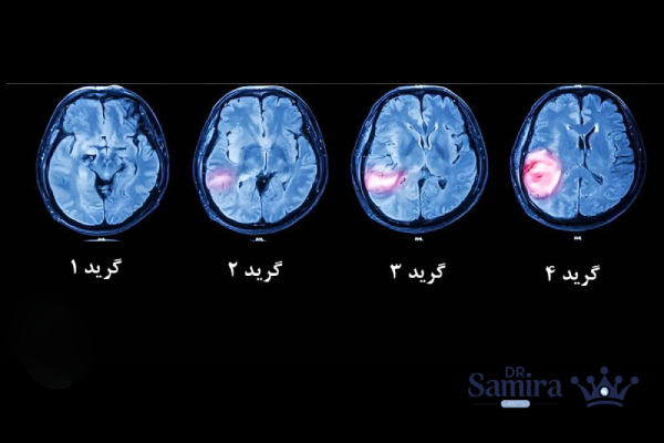 درمان الیگودندروگلیوم گرید ۲