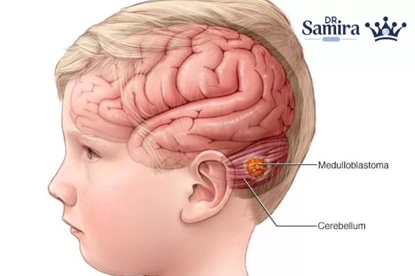 روشهای تشخیص گلیوم ساقه مغز