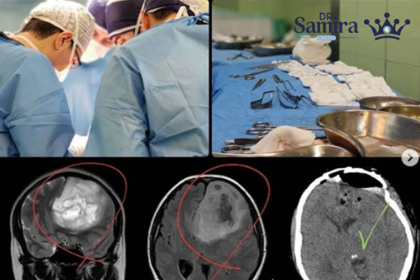 روشهای درمان گلیوبلاستوم