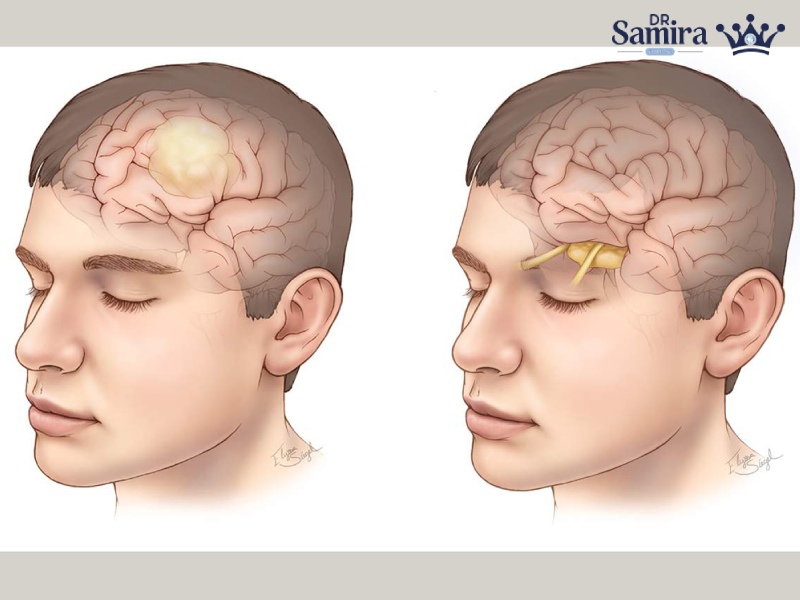 شوانوم عصب شنوایی از تشخیص تا درمان