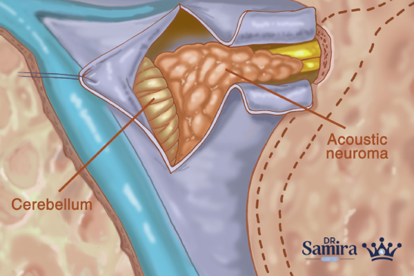 علت ایجاد شوانوم عصب شنوایی