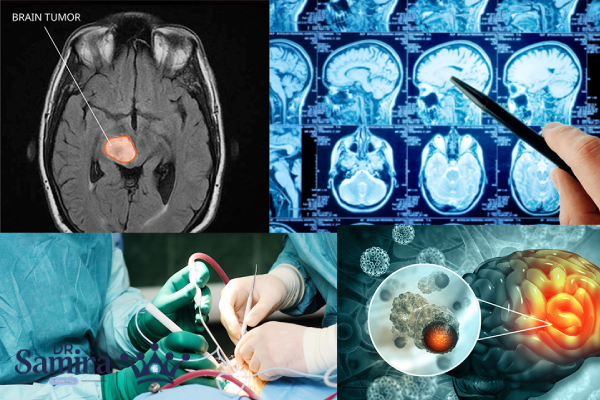 عوارض عدم درمان اپاندیموم گرید ۳