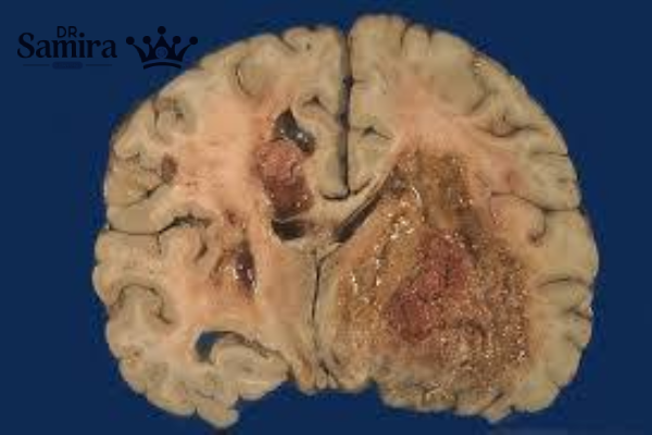 مراحل پیشرفت بیماری