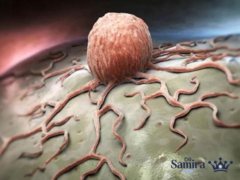 گلیوبلاستوم مولتی فرم (GBM) چیست؟