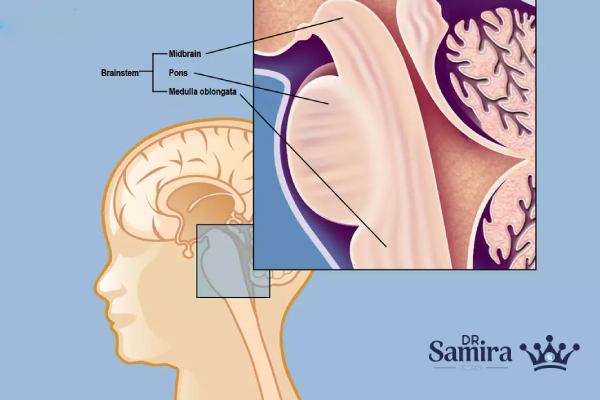 گلیوم ساقه مغز چیست؟
