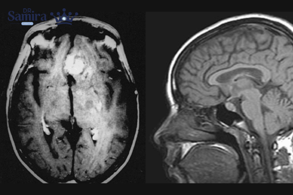 تومورهای سلولهای زاینده چیستند؟