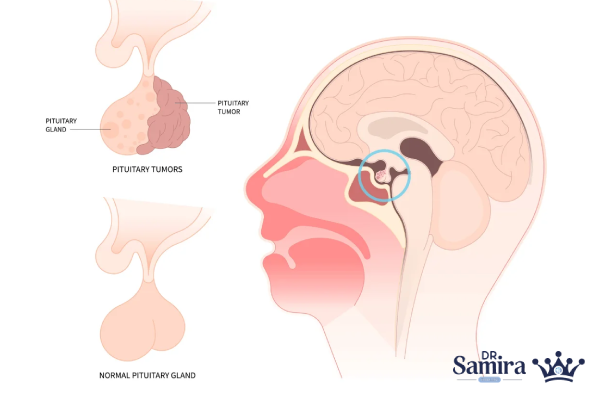 درمان کیست آراکنوئید مغز