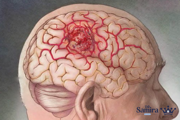 درمانهای اصلی لنفوم مغز