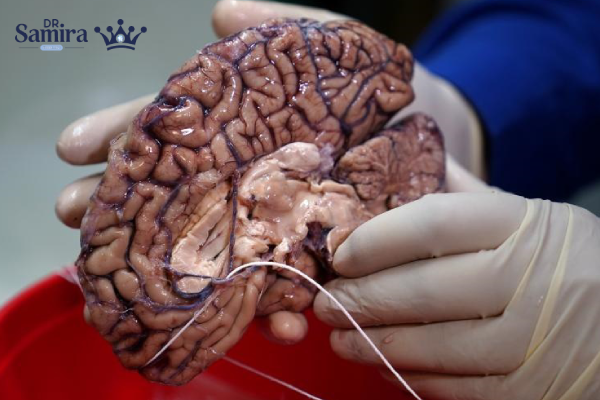 زندگی پس از تشخیص لنفوم مغز