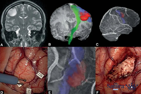 لنفوم مغز چیست؟