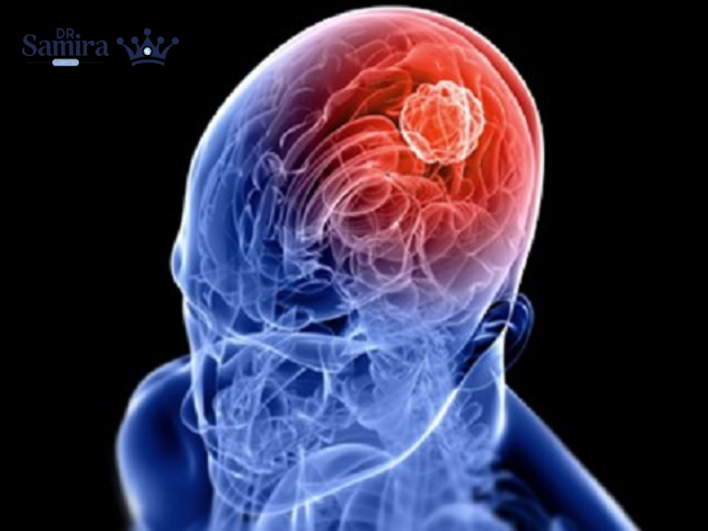 پیلو‌سیستیک گلیوما