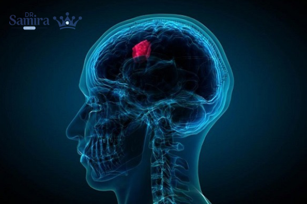 پینئوبلاستوم چیست؟