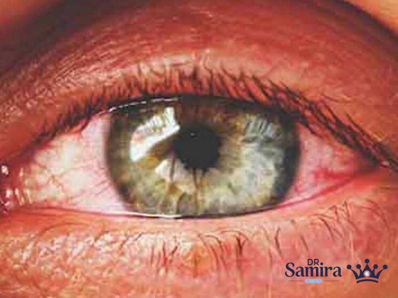 گلیوم عصب اپتیک چیست و نحوه درمان آن