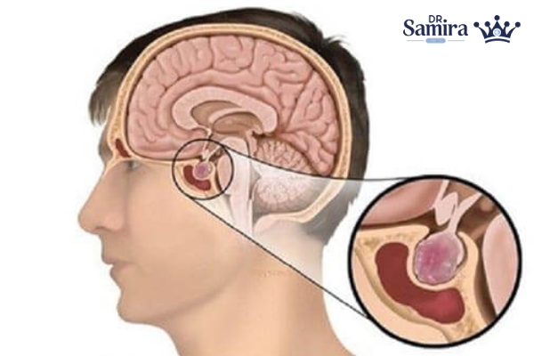 آدنوم ACTHساز هیپوفیز و ایجاد بیماری کوشینگ