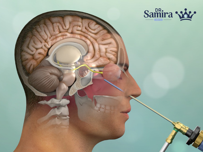 انواع آدنوم هیپوفیز چیست؟