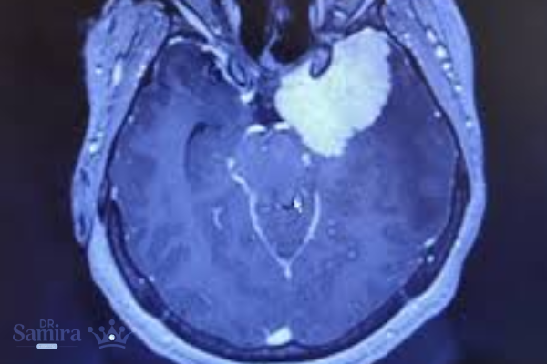 اهمیت تشخیص زودهنگام مننژیوم سینوس