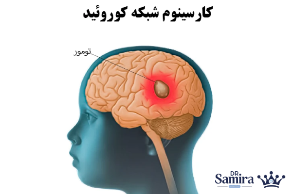 تفاوت پاپیلوما کوروئید پلکسوس با کارسینوم کورویید پلکسوس