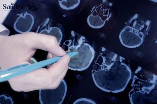 درمان پاپیلوما کوروئید پلکسوس چگونه انجام میشود؟