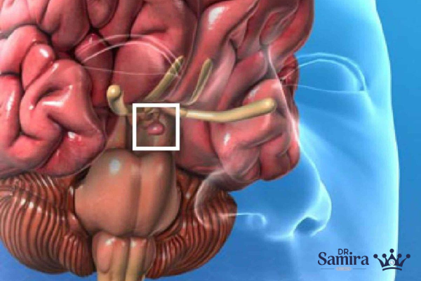 دستهبندی آدنومهای هیپوفیز بر اساس ترشح هورمون